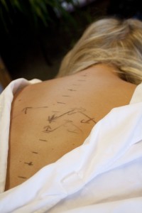 T8, T9 vertebrae and rib subluxations Colorado Springs light force chiropractic