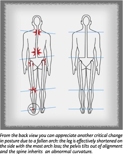 Sole Supprts posture diagram Posture correction possible with Sole Supports custom foot orthotics